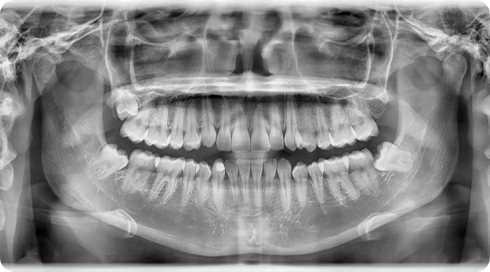 Radiografias Digitales 2D 2 Radiografías dentales radiobeam radiografias digitales img 02