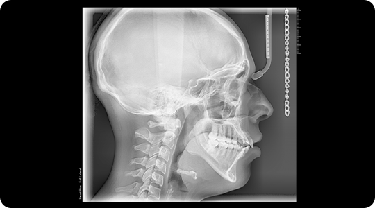 Radiografias Digitales 2D 3 Radiografías dentales radiobeam radiografias digitales img 03