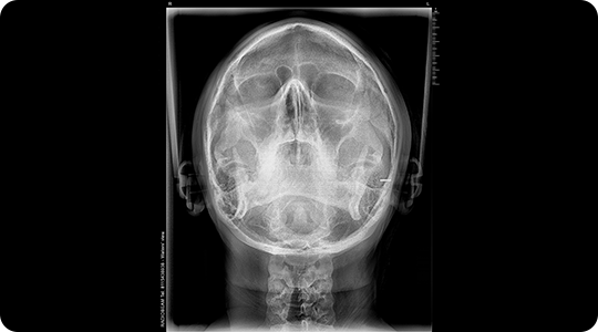 Radiografias Digitales 2D 5 Radiografías dentales radiobeam radiografias digitales img 05