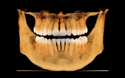 tomografia-conebeam-10×7 tomografia-conebeam-10x7