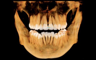 tomografia-conebeam-10×8-5 tomografia-conebeam-10x8-5