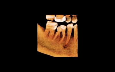 tomografia-conebeam-5×5 tomografia-conebeam-5x5